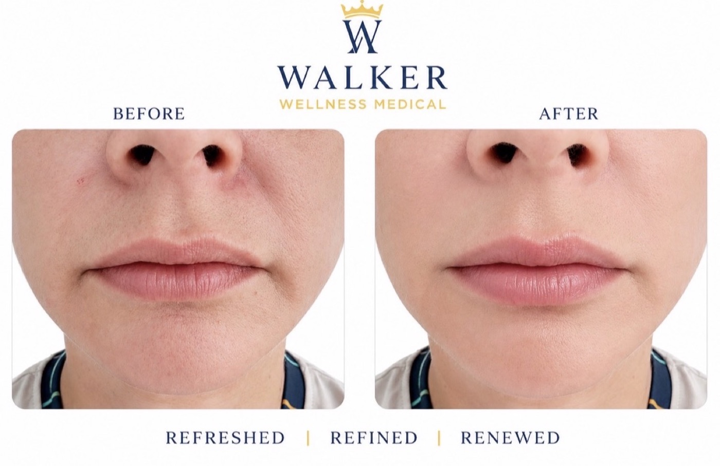 Before and after close-up of lip filler results at Walker Wellness Medical, showing fuller, more refined lips.