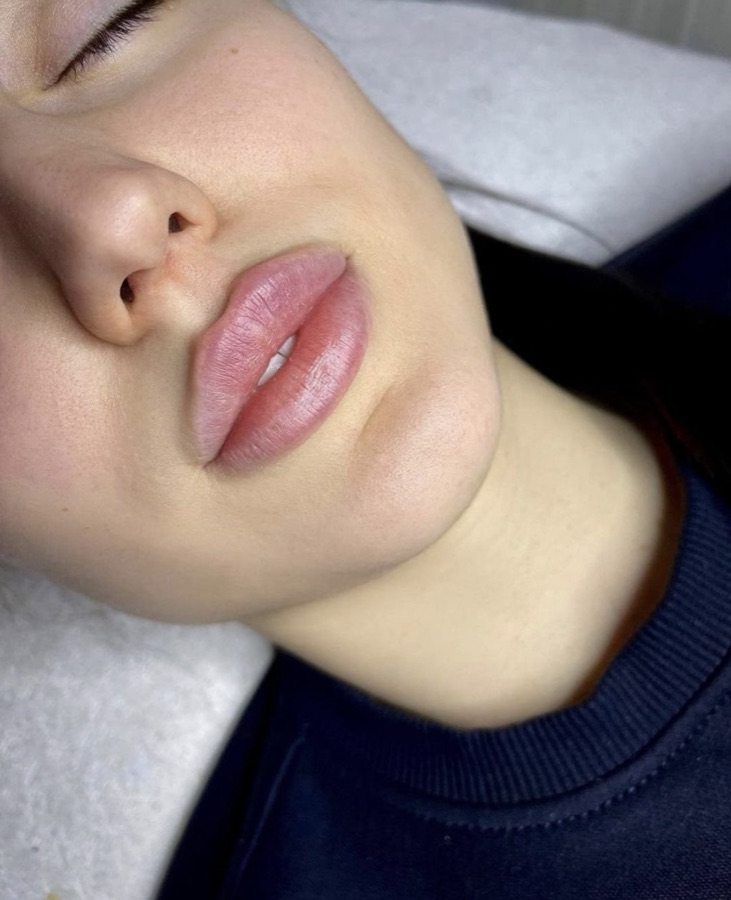 Close-up photo of natural-looking lip filler results at Walker Wellness Medical.